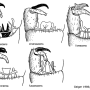 Dicranoptycha fuscescens : hypopygium